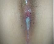 Erupci&oacute;n anal from rashe sex nude