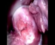 Cuzco's view of the cervix and vaginal wall from www xxx of sanaya i
